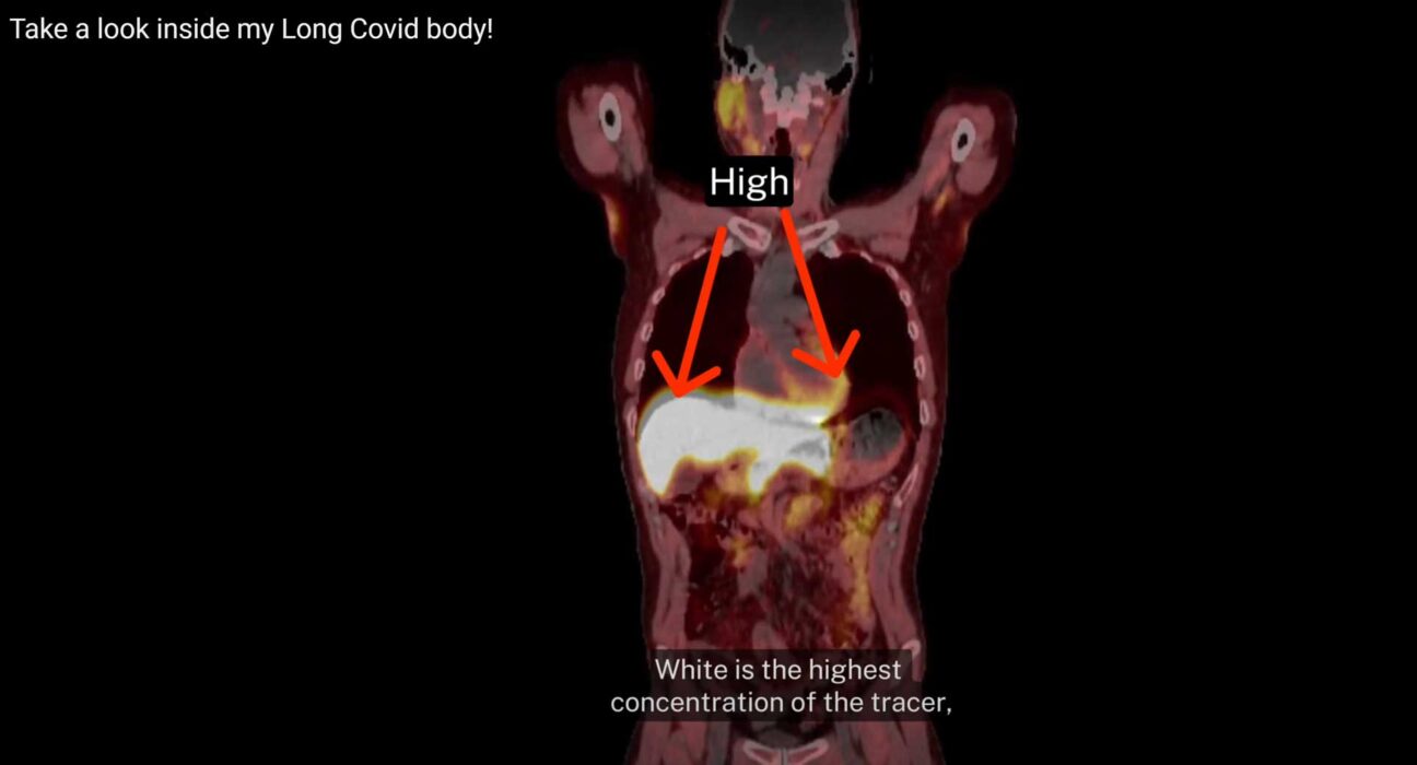 long-covid-visual-imaging