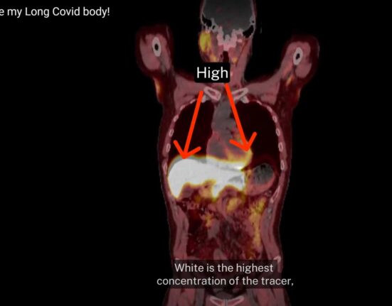 long-covid-visual-imaging